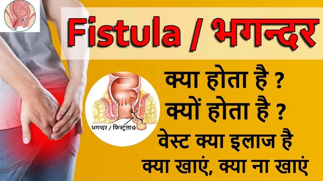 भगन्दर, (फिस्टुला) - प्रकार, लक्षण, कारण, इलाज और परहेज | Fistula In Hindi