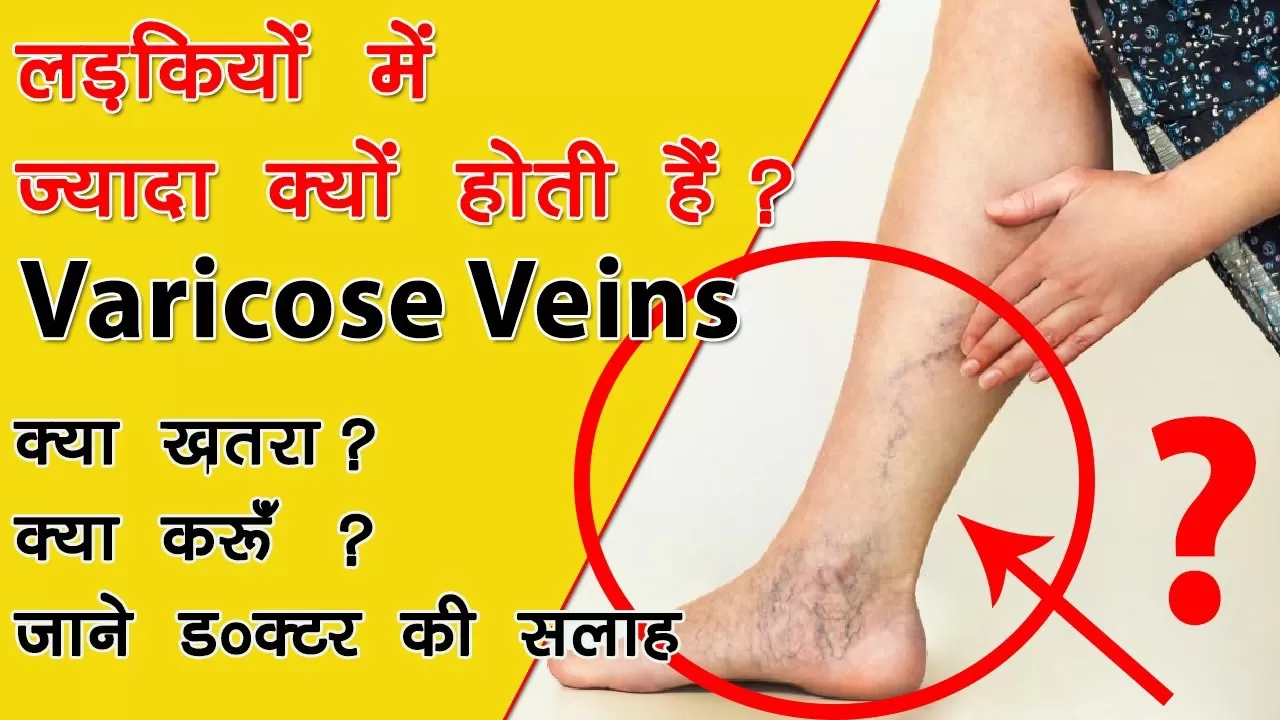 वैरिकोज वेन्स