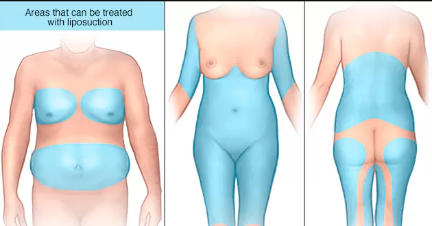 Liposuction 1