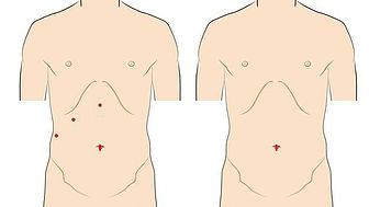 single-incision-surgery-4