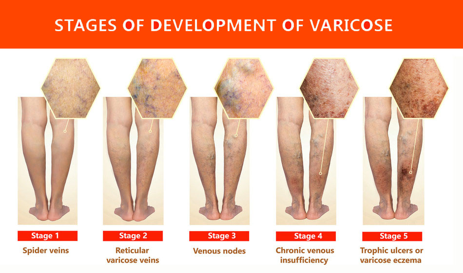 Vehius varicoză, Care este diferența dintre detraleks și venarus