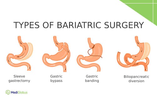 best-weight-loss-surgery-in-fazilka-top-bariatric-surgeon-fazilka