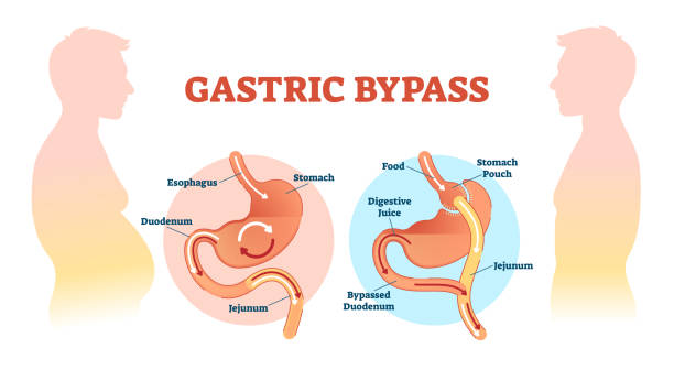 weight loss surgery / bariatric surgery image 