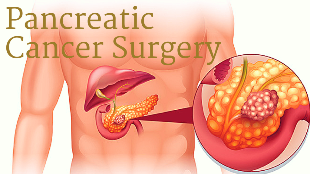 Pancreas Cancer Surgery In Jalandhar 1 Best Hospital 7852
