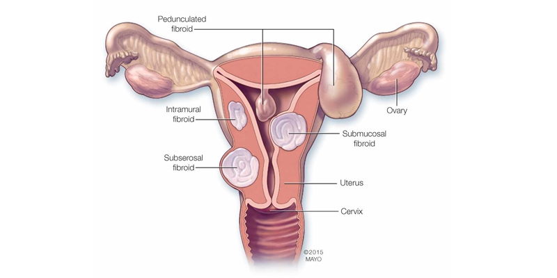 Fibroid Removal In Jalandhar