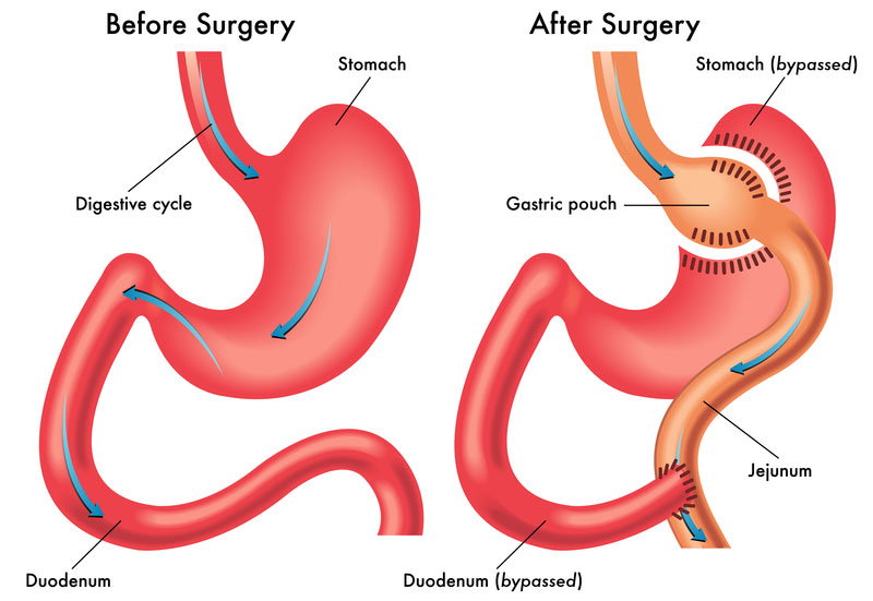 Baraitric Surgery In Sultanpur Lodhi 