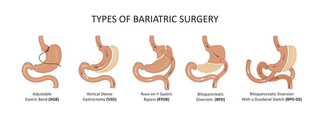 Bariatric surgery In Haryana