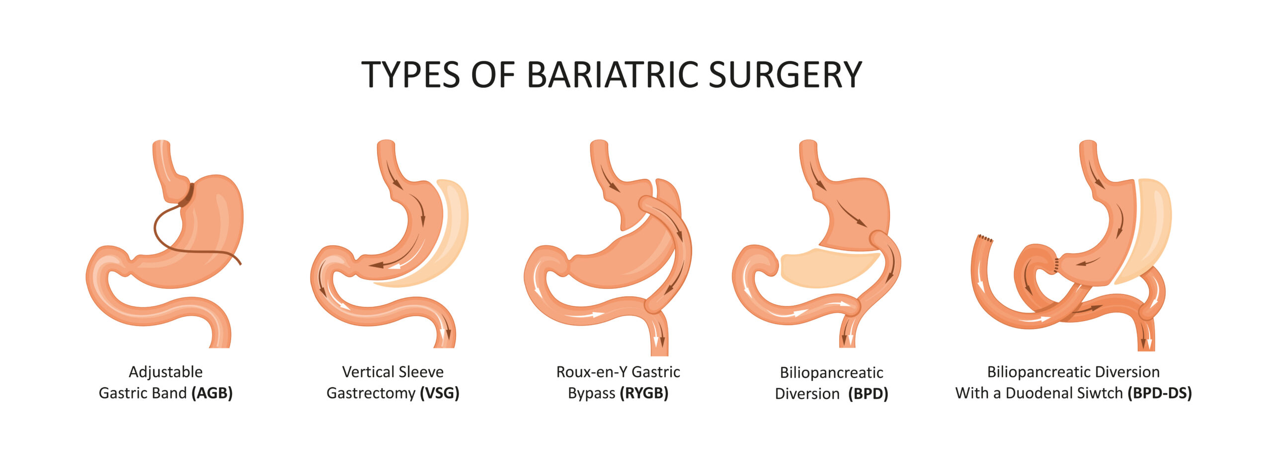 Bariatric Surgery In Samrala
