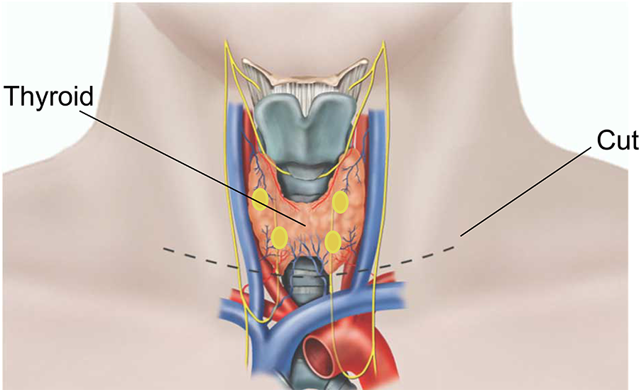 thyroid surgery in punjab