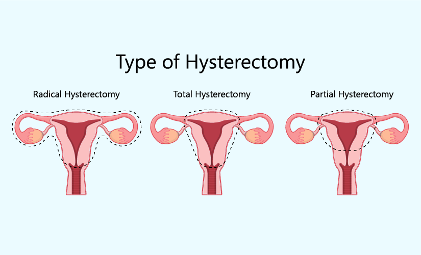 Hysterectomy Surgery In Hoshiarpur 