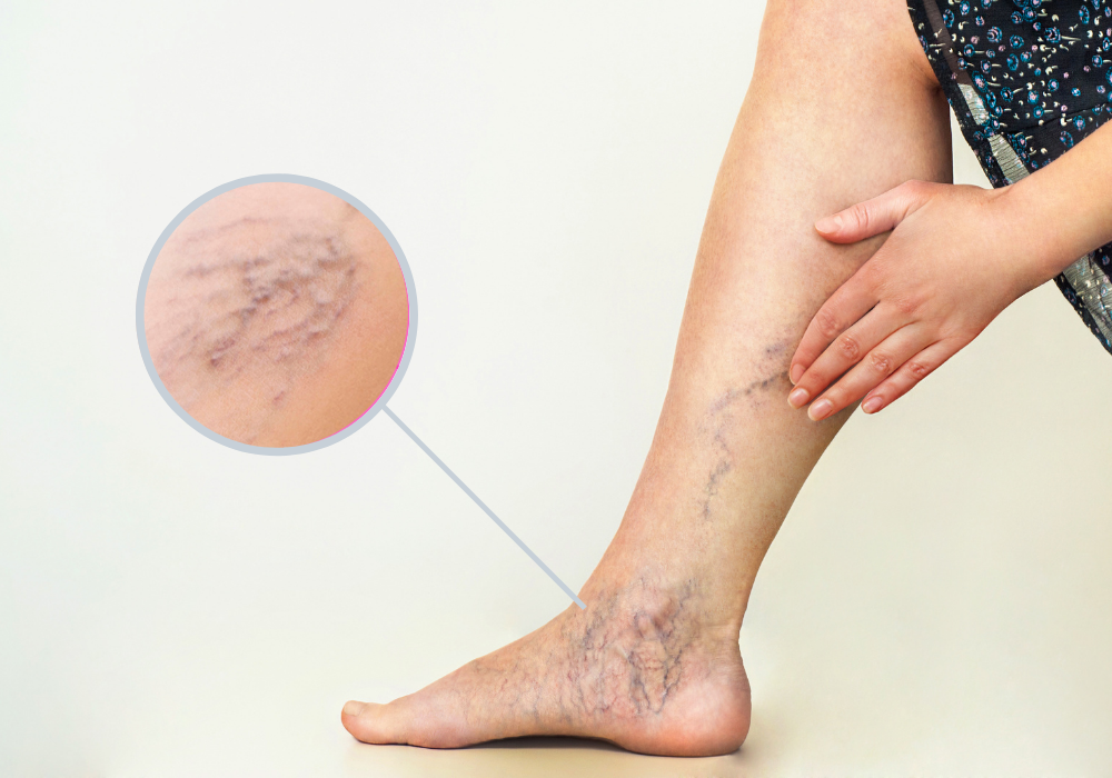 Varicose Veins Treatment In Hoshiarpur 