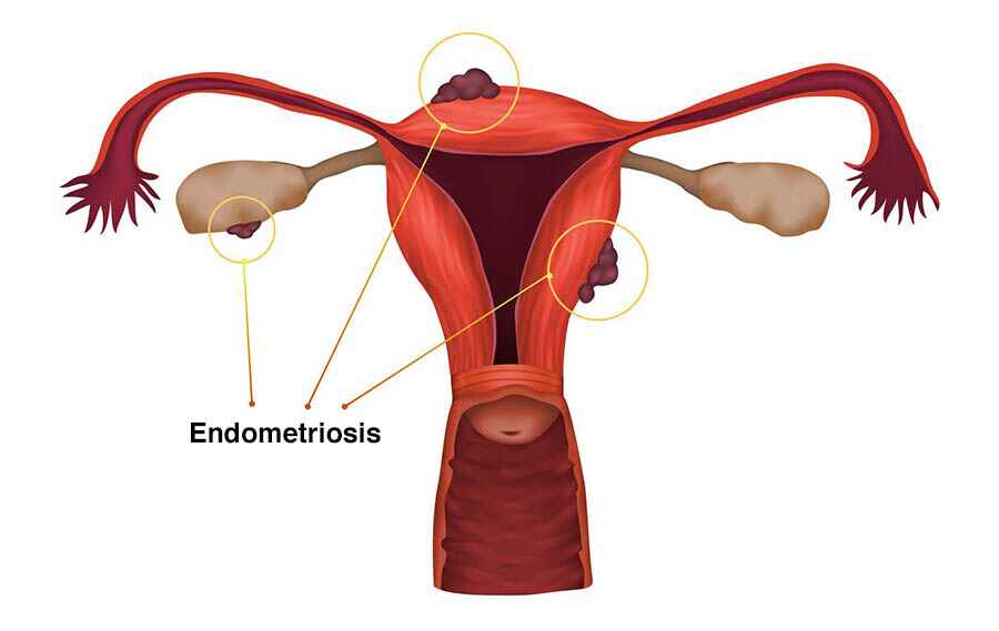 Endometriosis Treatment in Jalandhar