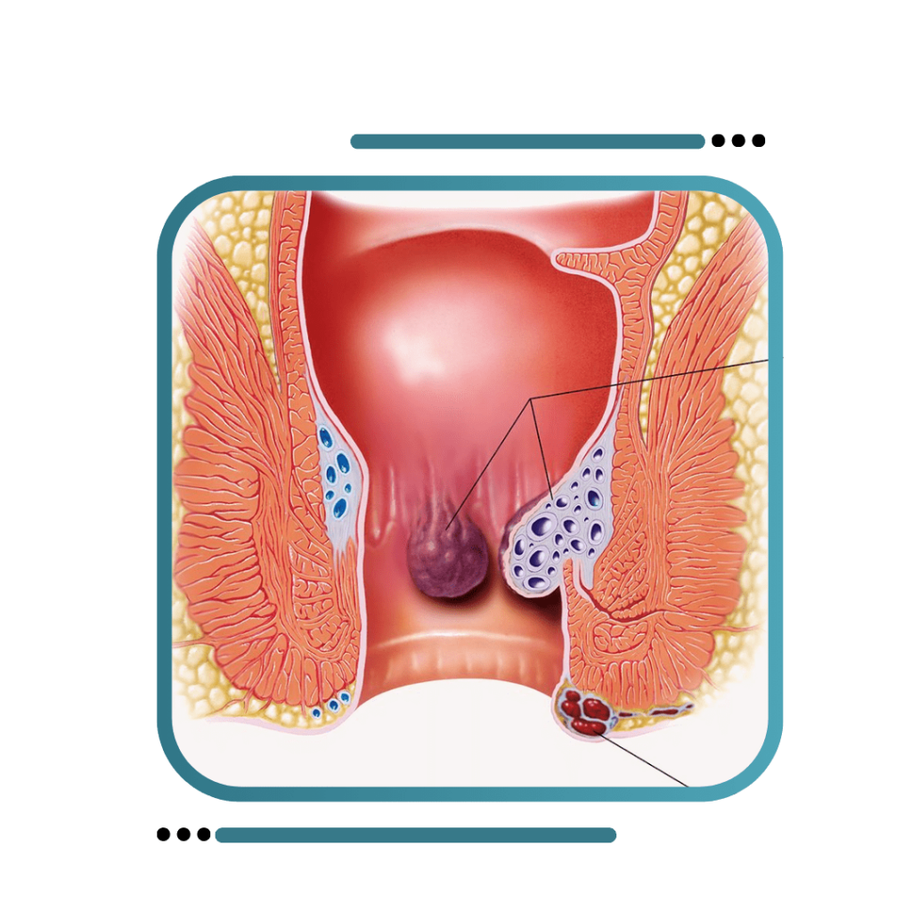 Best Hemorrhoids Treatment in Jalandhar