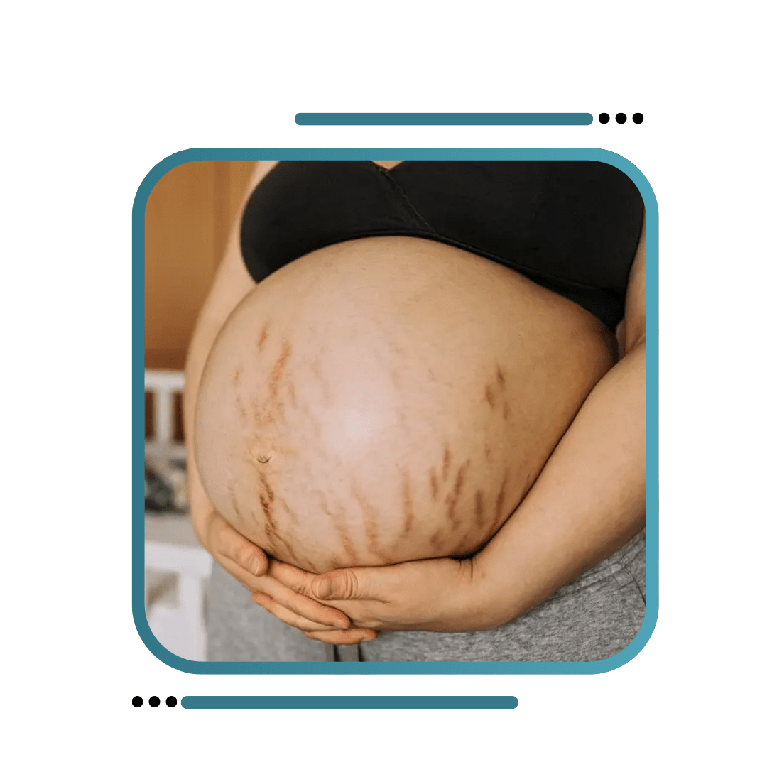 Pregnancy Stretch Marks Removal Treatment in India