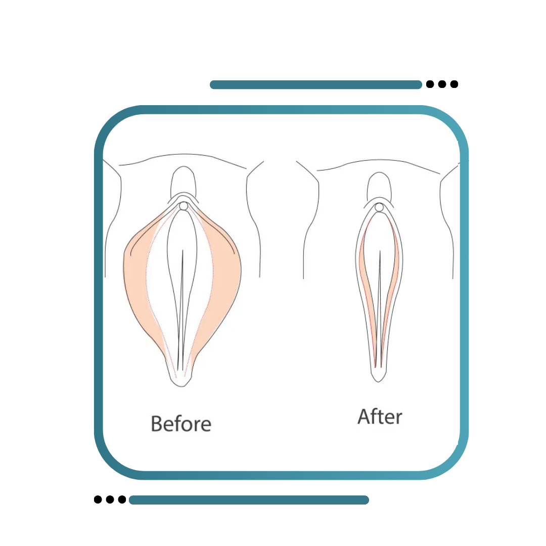 Labiaplasty Surgery In Jalandhar