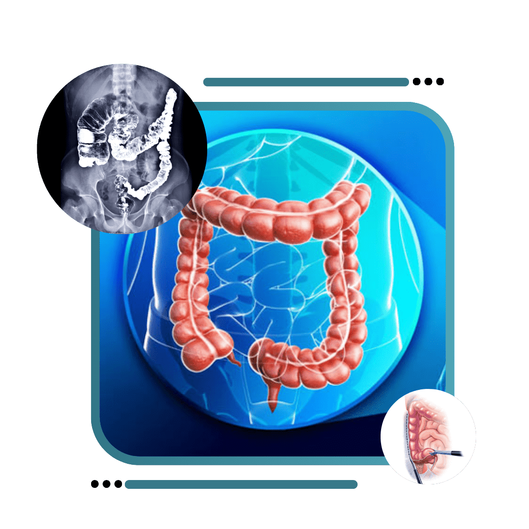 LAPAROSCOPIC COLON & RECTUM SURGERY IN JALANDHAR​