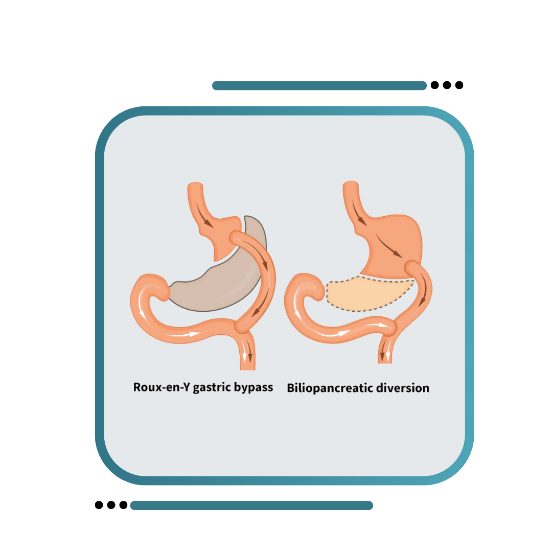 Metabolic / Diabetic Surgery Punjab