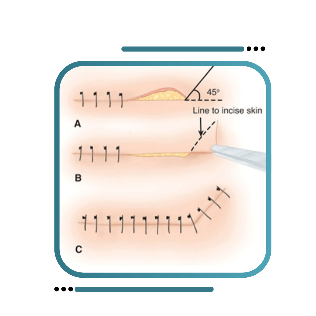 Dog Ear Correction Surgery In India