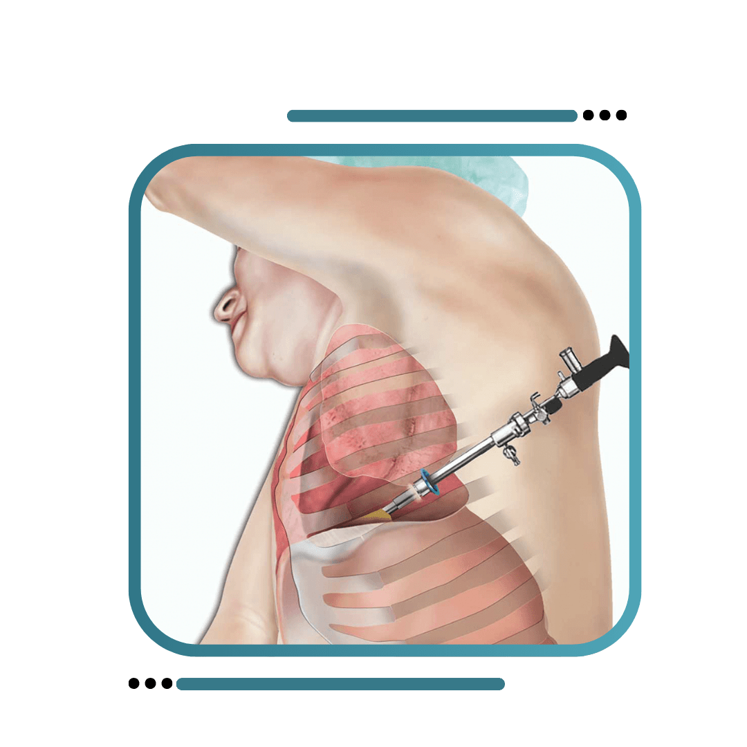 Thoracoscopic Surgery in Jalandhar