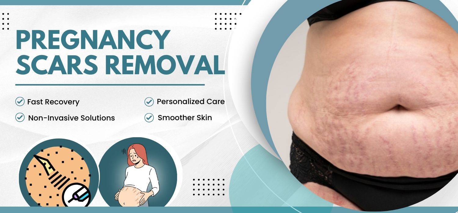 Pregnancy Stretch Marks Removal Treatment in India