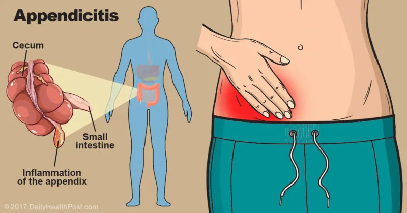 appendix surgery