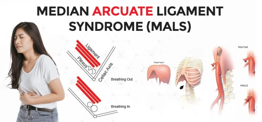 Median Arcuate Ligament Syndrome treatment In India | (MALS Surgery)