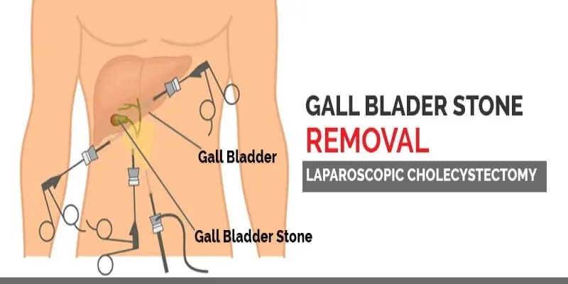 Best Gallbladder Stone Surgery In Fazilka