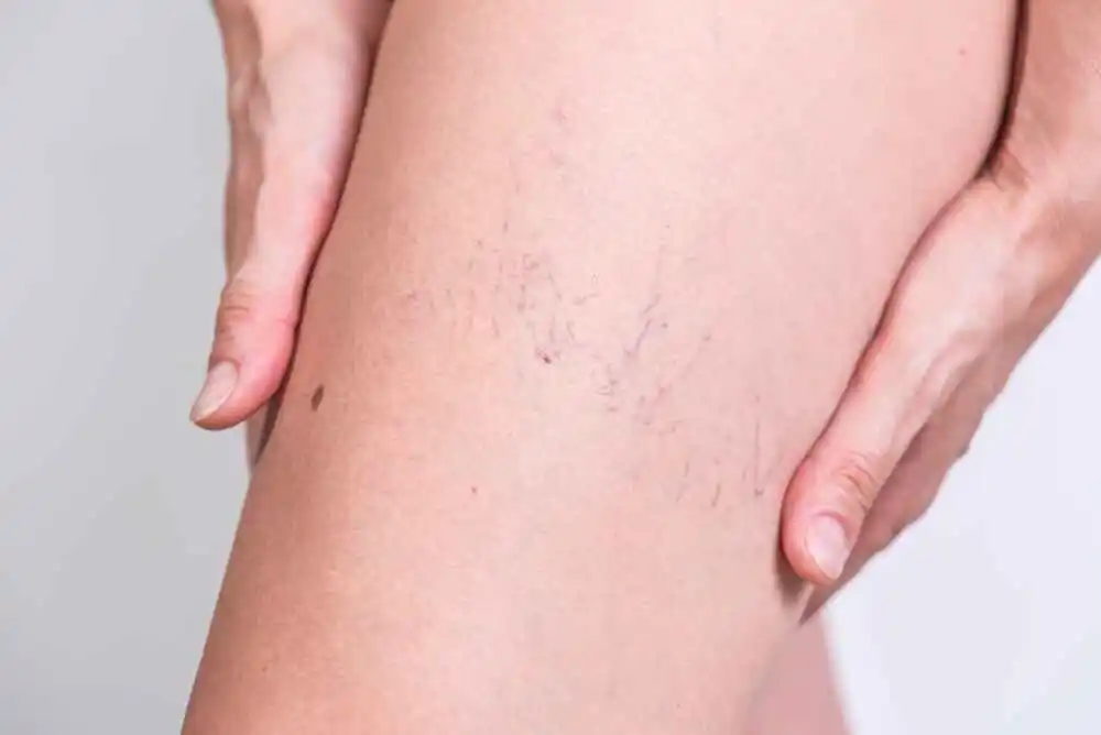 spider veins