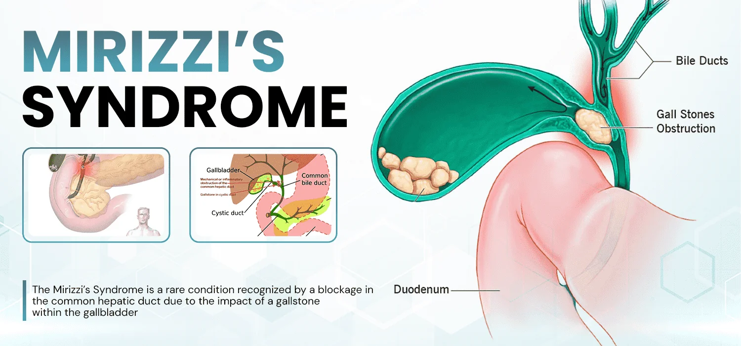 Mirizzi’s Syndrome