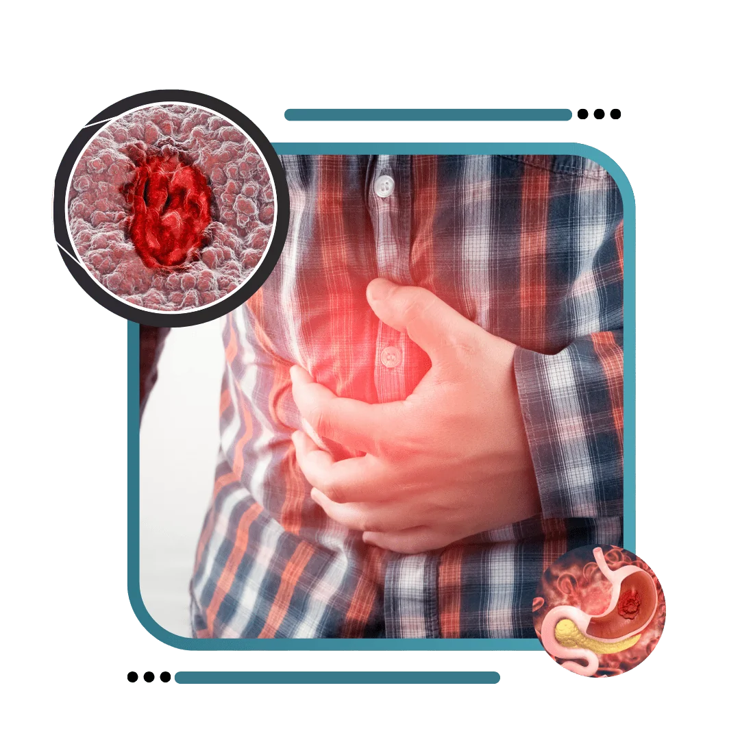 PEPTIC ULCER PERITONITIS