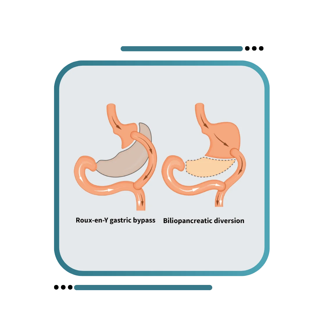 Metabolic / Diabetic Surgery Punjab