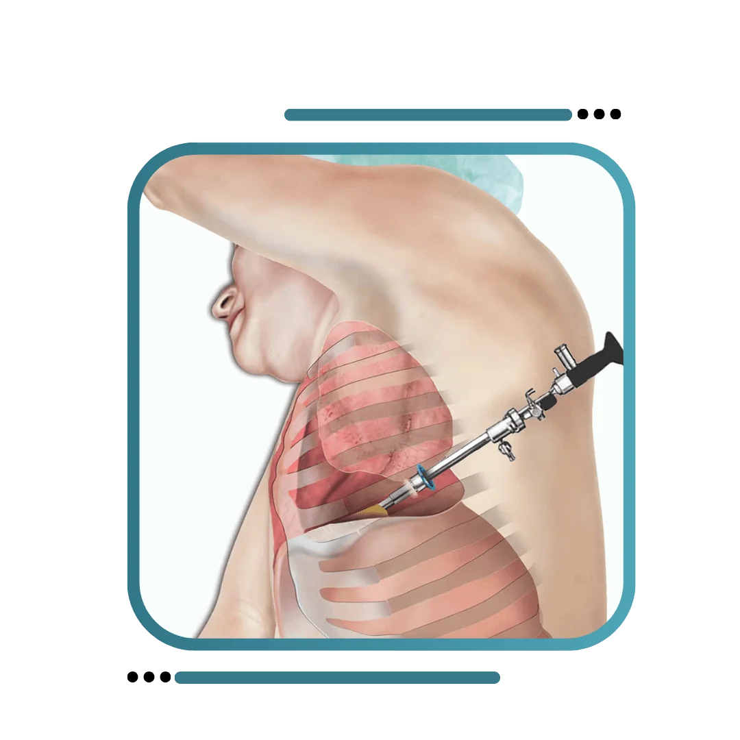 Thoracoscopic Surgery in Jalandhar