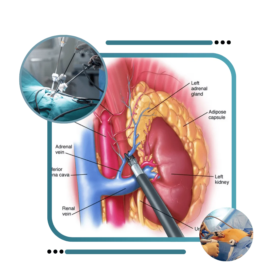 Laparoscopic Adrenalectomy Surgery In India